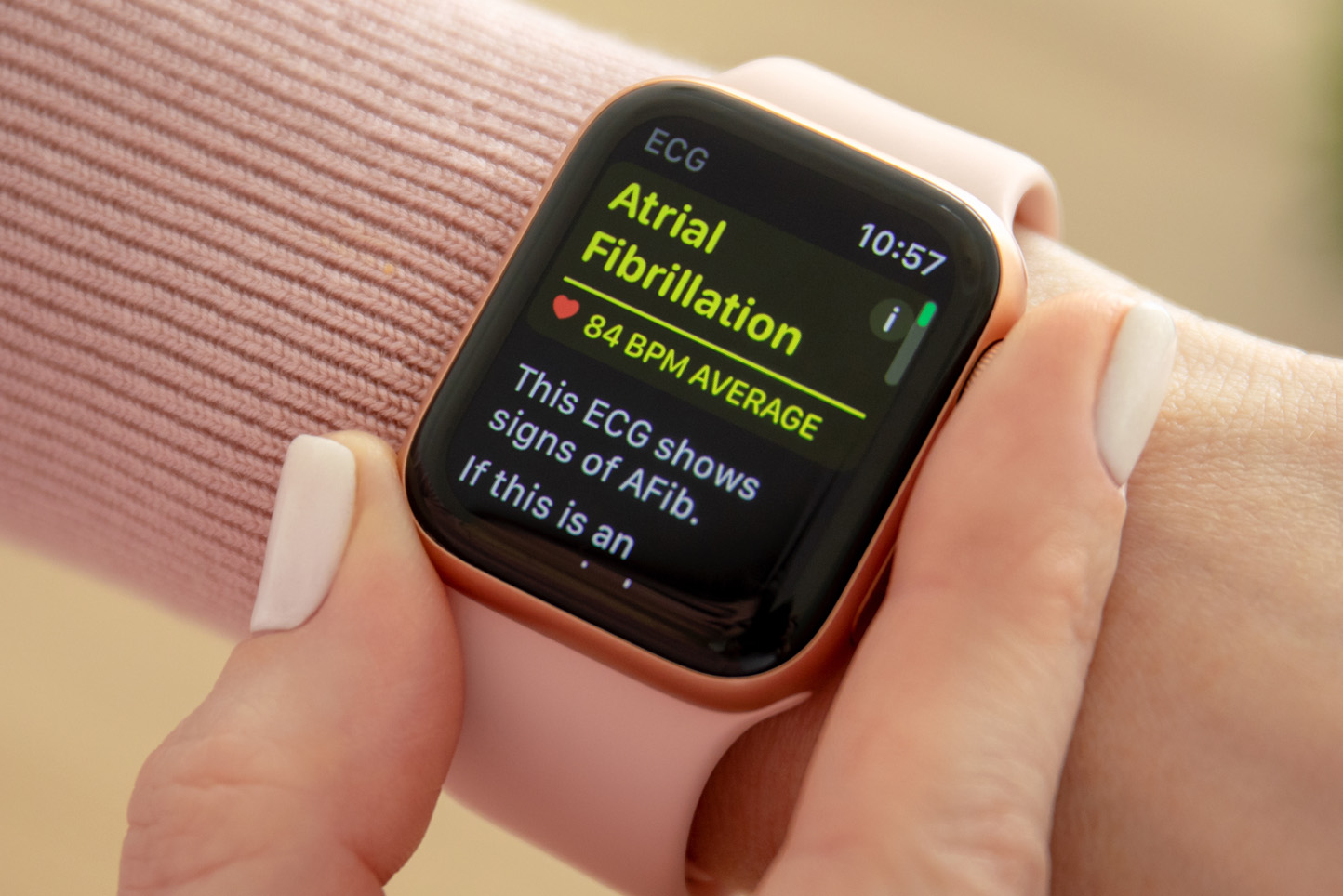 Apple Watch Showing ECG Warning for Arterial Fibrillation